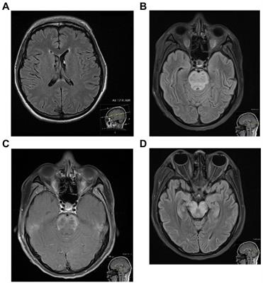 The conundrum of neuropsychiatric systemic lupus erythematosus: Current and novel approaches to diagnosis